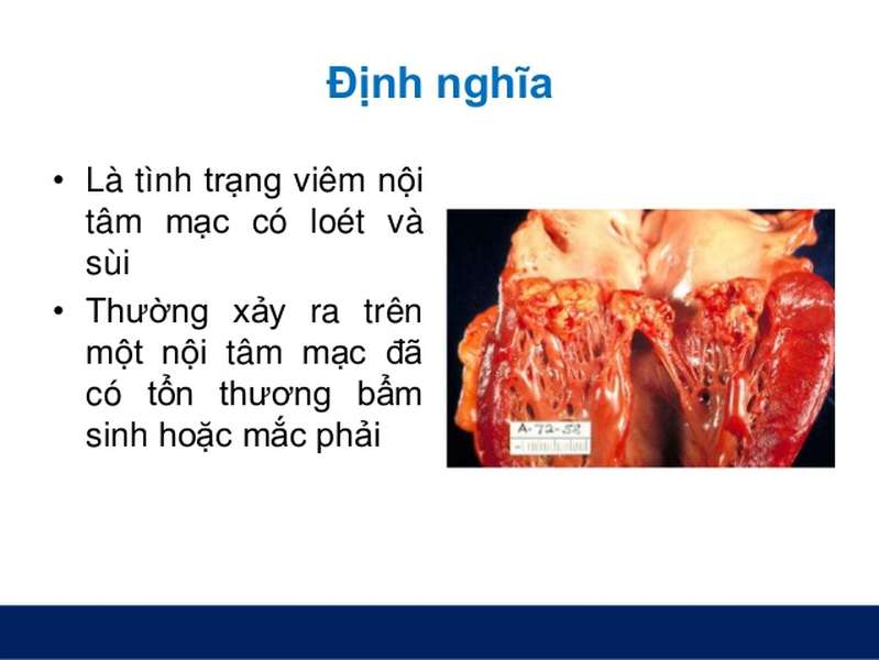 Ảnh 3 của Infective endocarditis
